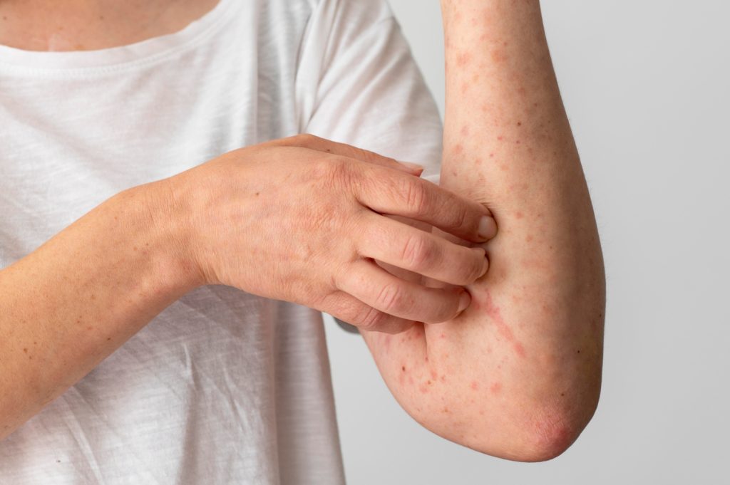 Chickenpox