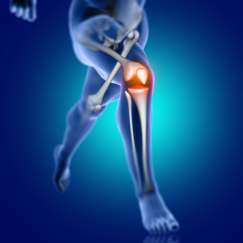 Arthritis (Osteoarthritis)