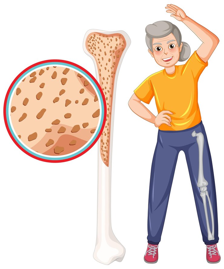 Brittle Bone Disease