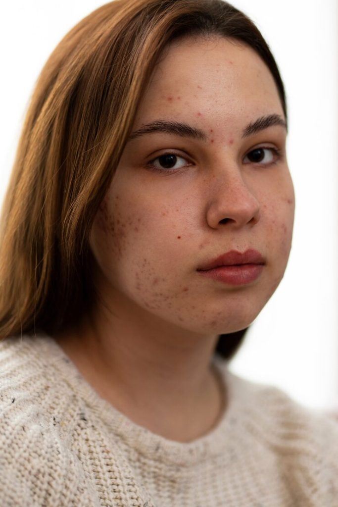 Pigmented Birthmarks