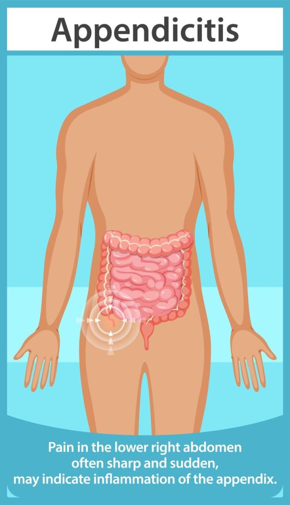Appendicitis